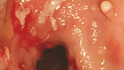 КЛИНИЧЕСКИЕ РЕКОМЕНДАЦИИ ПО ДИАГНОСТИКЕ И ЛЕЧЕНИЮ БОЛЕЗНИ КРОНА У ВЗРОСЛЫХ (ПРОЕКТ) 2020